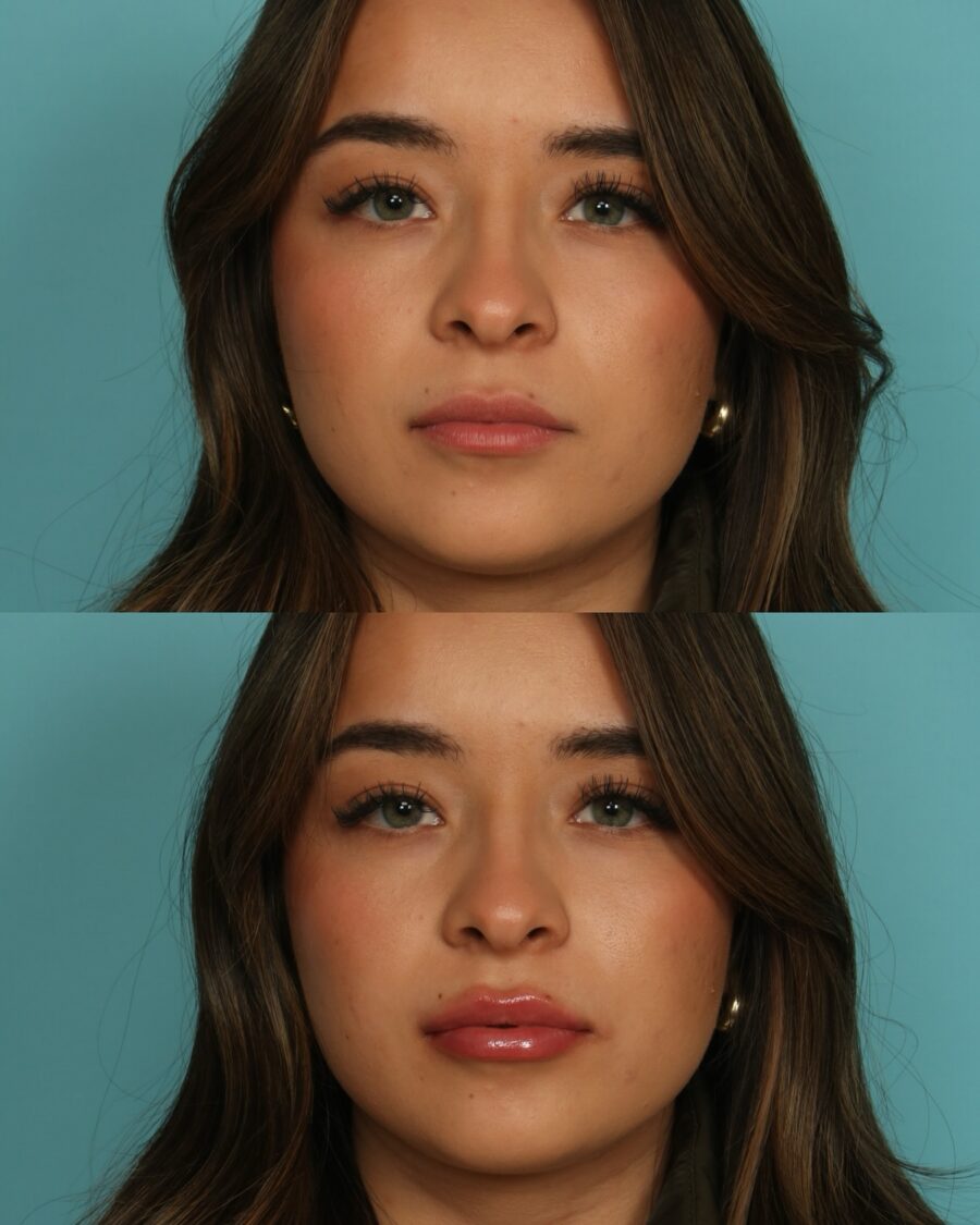 Transforming Thin Lips with Glossy Finish