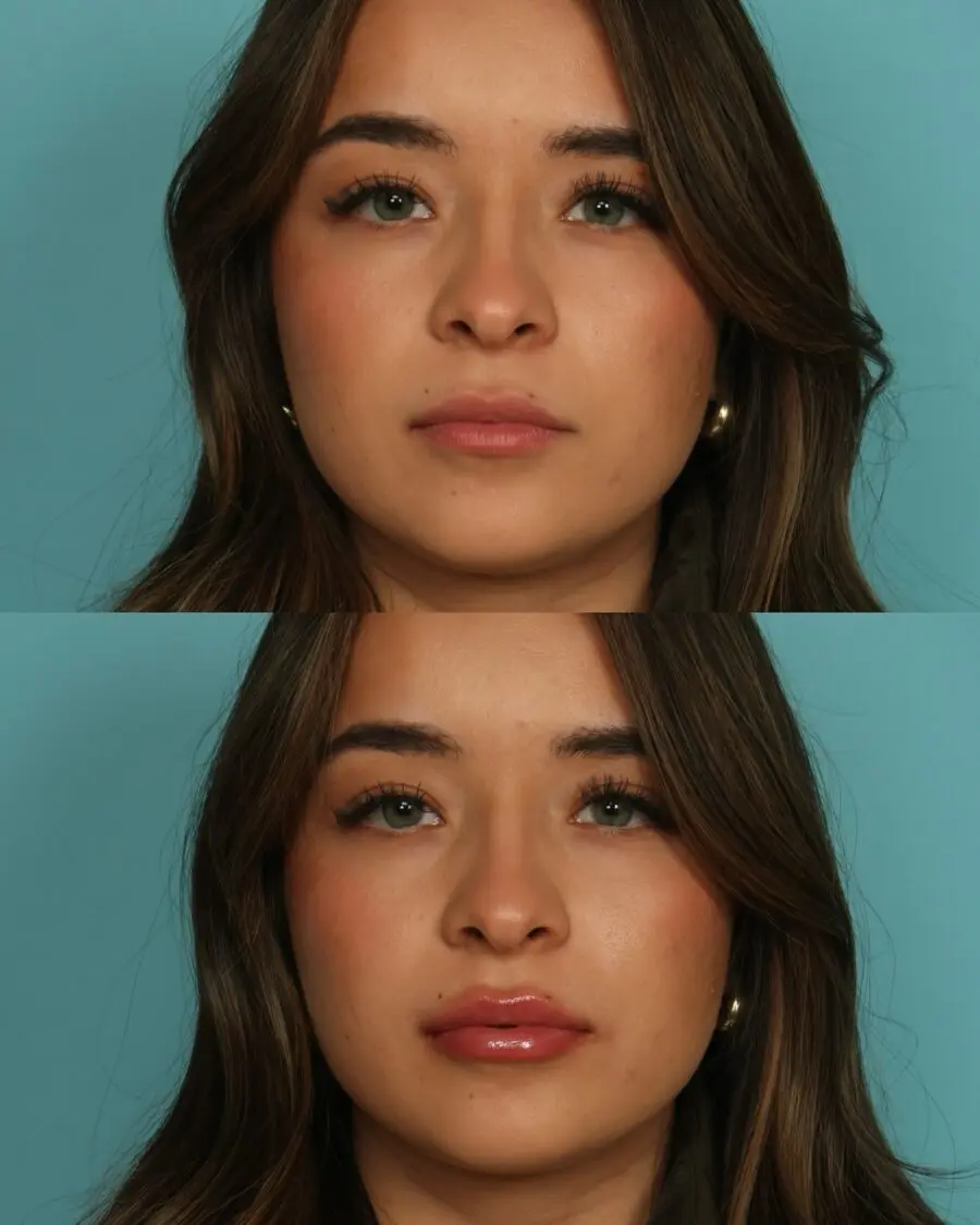 Transforming Thin Lips with Glossy Finish