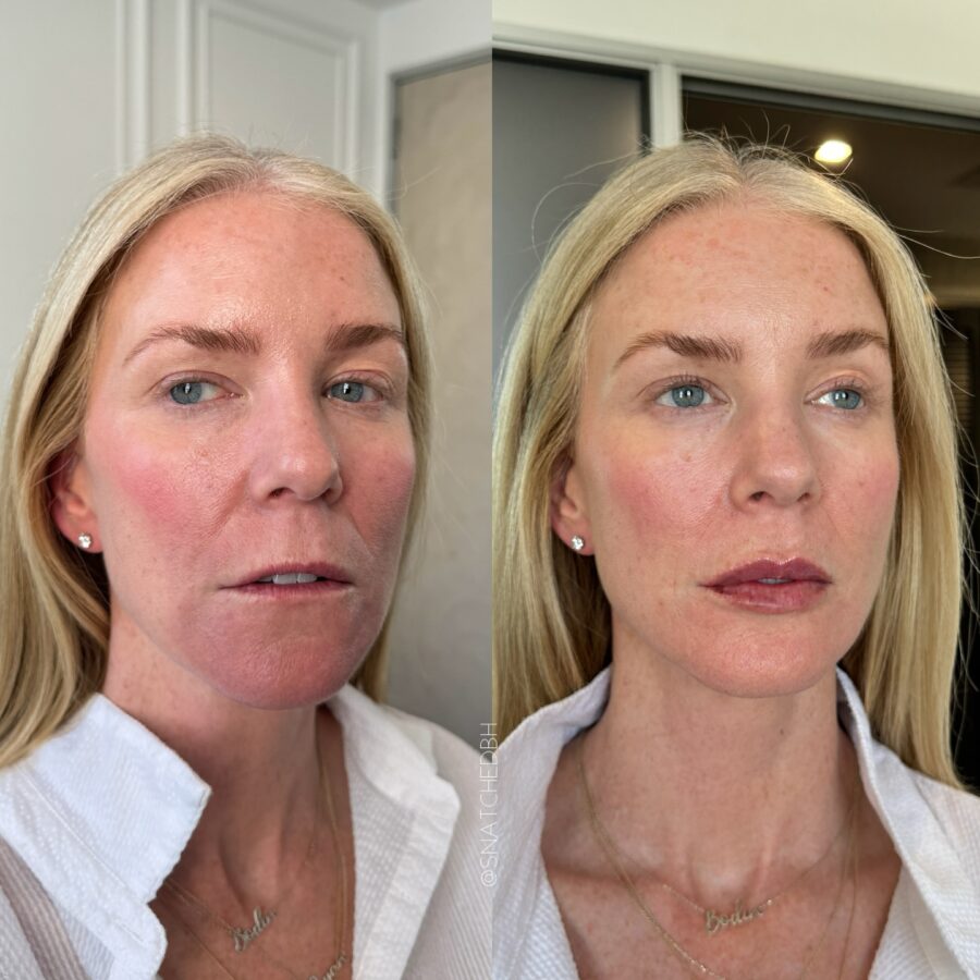 Stunning transformation with subtle lip enhancement