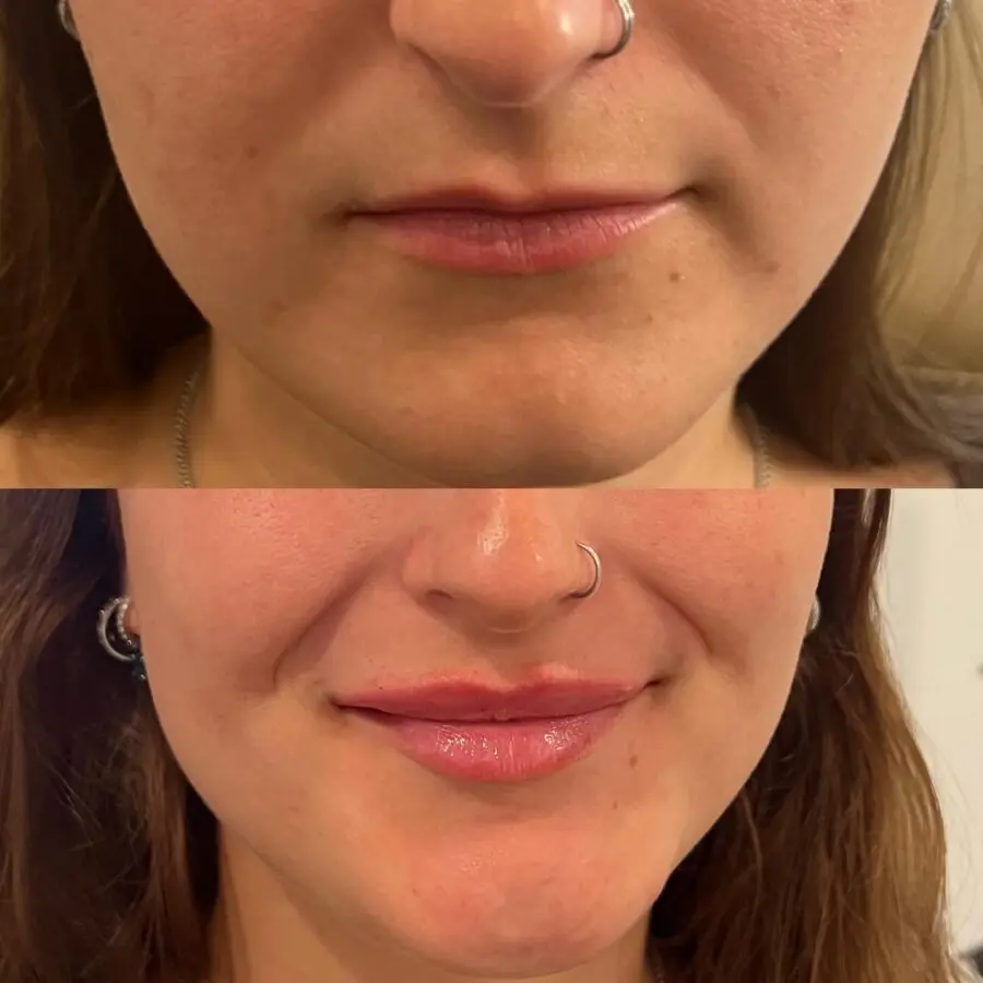 Subtle transformation for fuller-looking lips