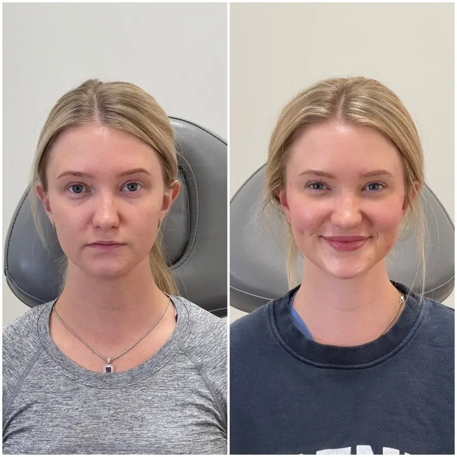Before and After Thin Lips Makeup Transformation